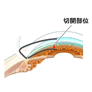 手術内容2