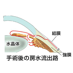 手術内容2