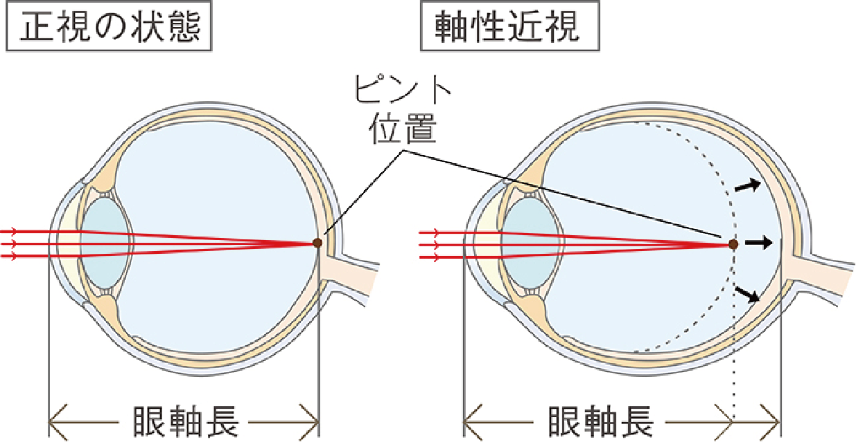 近視の進行を抑制することが大切な理由