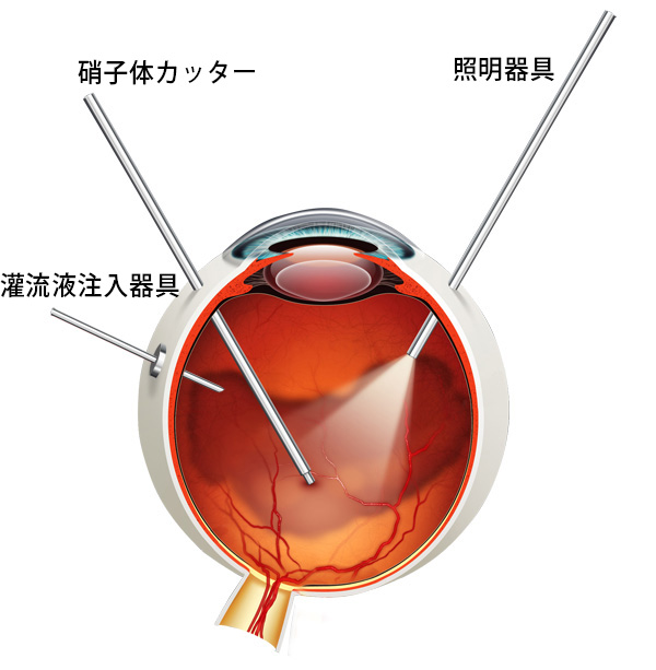 手術方法