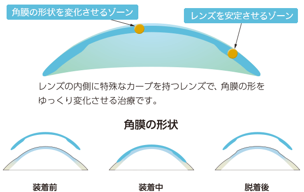 レンズの内側に特殊なカーブを持つレンズで、角膜の形をゆっくり変化させる治療です。