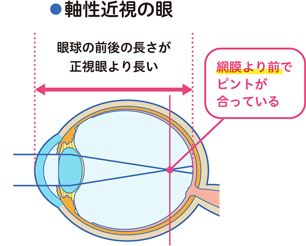 軸性近視の眼